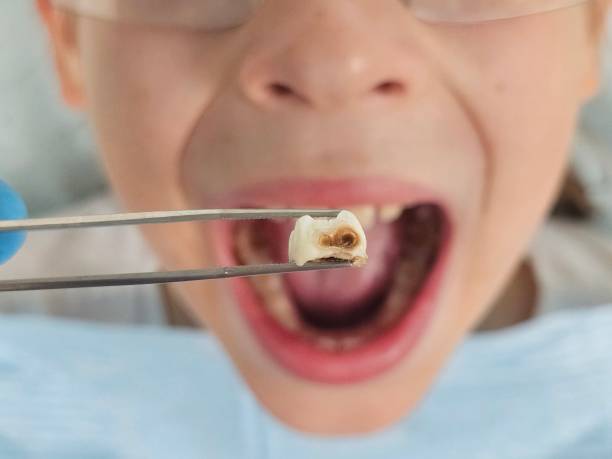 Best Emergency Dental Care for Broken or Chipped Teeth in Logansport, IN